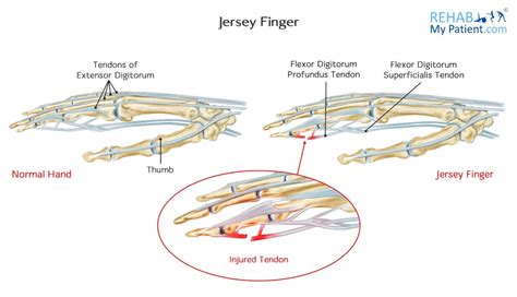 Jersey Finger .